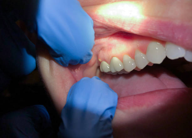 Best Emergency Dental Care for Broken or Chipped Teeth in Oaklyn, NJ